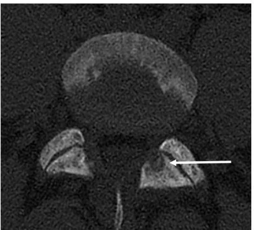 Vertebral osteoid osteoma: yayımlanmış olgu görüntüsü, sagittal kesit