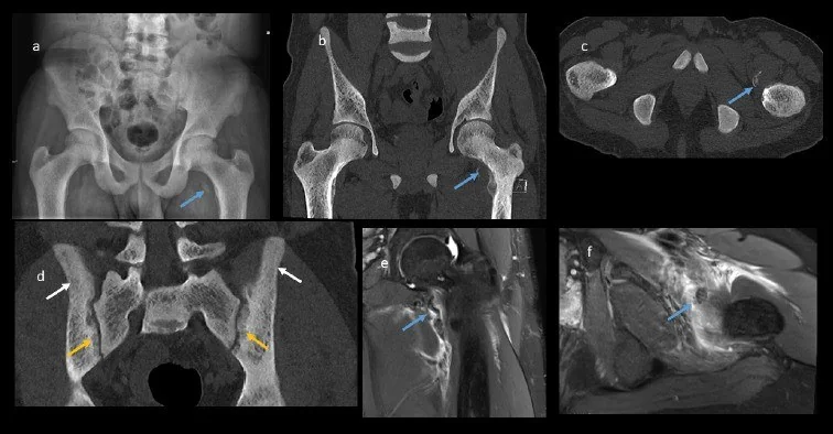 Osteomalazi ve renal osteodistrofi: yayımlanmış olgu görüntüsü, koronal kesit