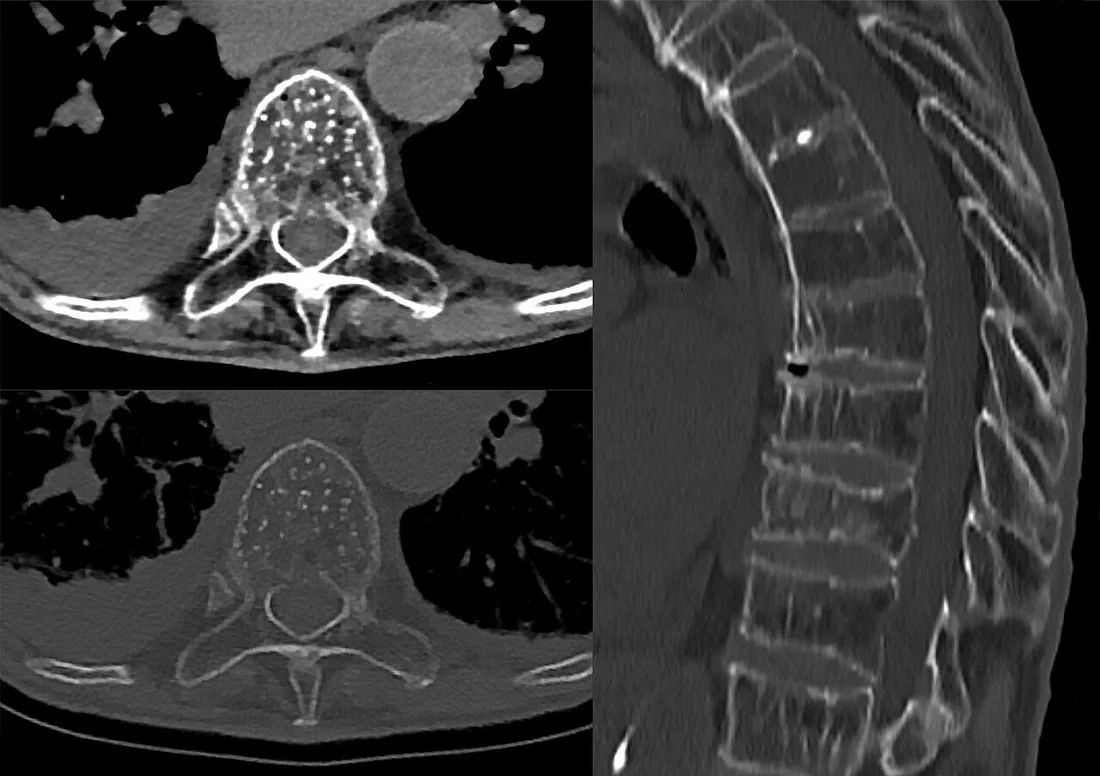 Osteoporotik vertebral deformite: yayımlanmış olgu görüntüsü, aksiyel kesit