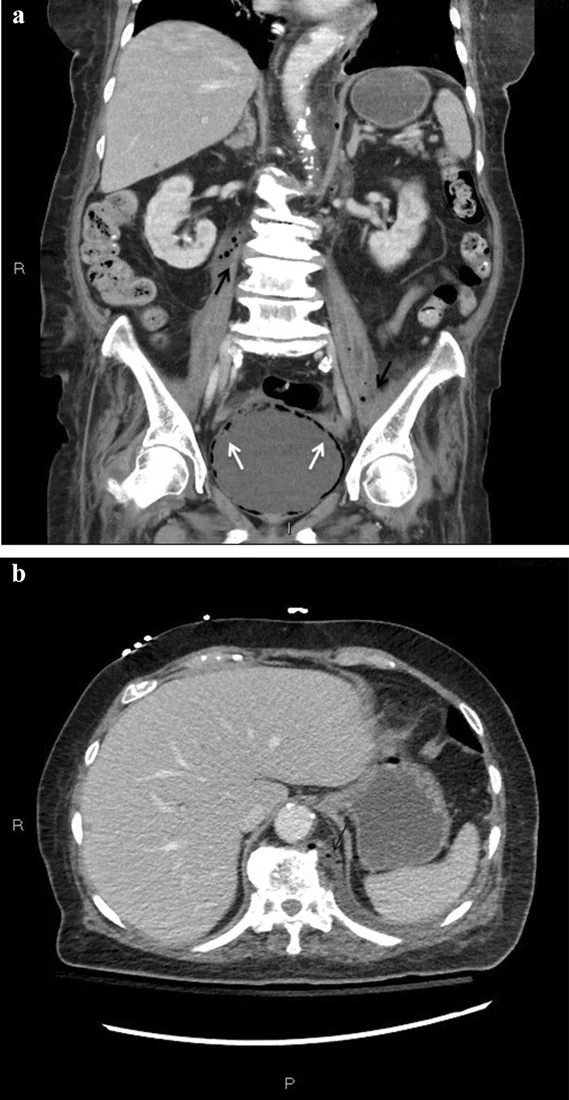 Paraspinal ve psoas enfeksiyöz koleksiyon: yayımlanmış olgu görüntüsü, koronal kesit