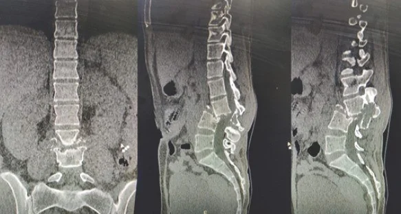 Soliter vertebral plazmasitom: yayımlanmış olgu görüntüsü, koronal+sagittal kesit