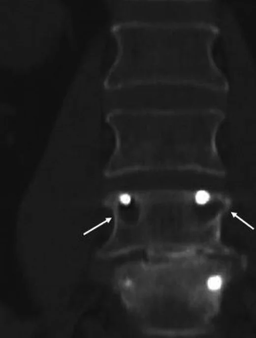 Spinal füzyon ve donanım çevresi BT bulguları: yayımlanmış olgu görüntüsü, sagittal kesit
