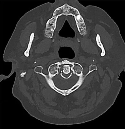 Retro-odontoid psödotümör ve CPPD birikimi: yayımlanmış olgu görüntüsü, aksiyel kesit
