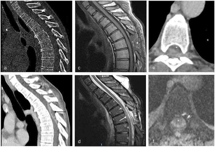 Spinal epidural apse: yayımlanmış olgu görüntüsü, sagittal kesit