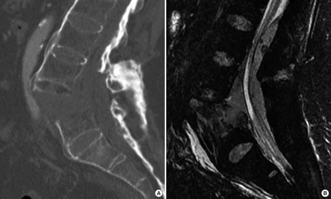 Spinal epidural hematomun BT görünümü ve sınırı: yayımlanmış olgu görüntüsü, sagittal kesit