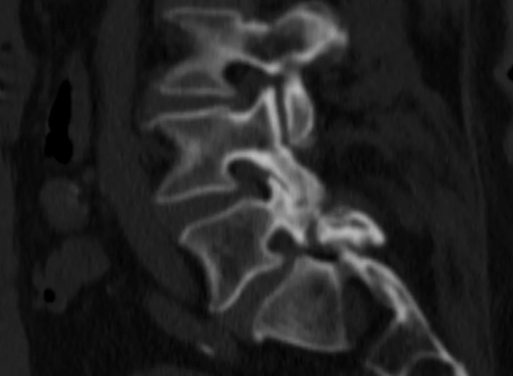 Spondilolizis (pars defekti): yayımlanmış olgu görüntüsü, sagittal kesit