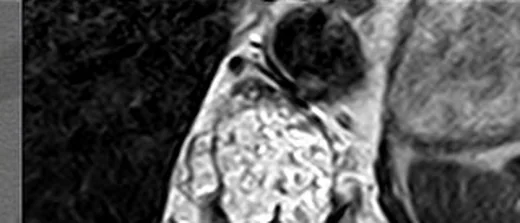 Atipik/agresif vertebral hemanjiom: yayımlanmış olgu görüntüsü, aksiyel kesit