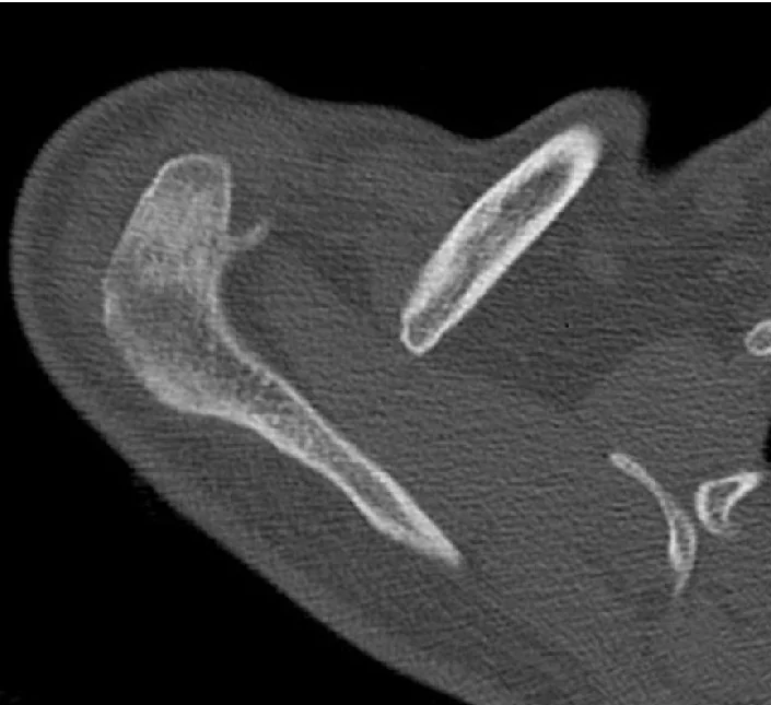Distal klavikula osteolizi: yayımlanmış olgu görüntüsü, aksiyel kesit