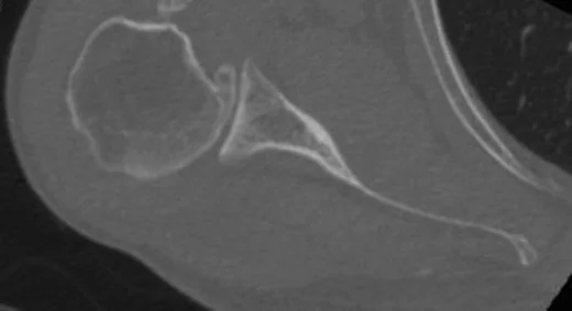 Glenohumeral osteoartrit: yayımlanmış olgu görüntüsü, aksiyel kesit