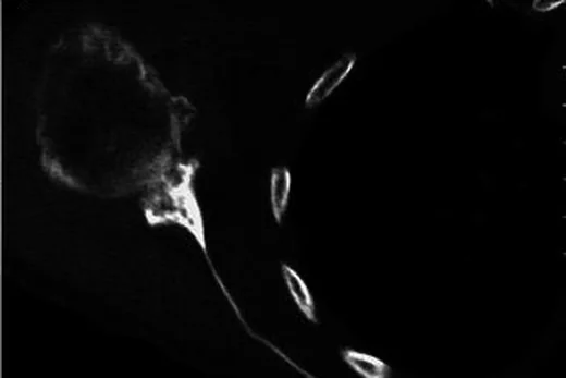 Glenoid gelişimsel displazisi: yayımlanmış olgu görüntüsü, aksiyel kesit