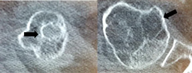 Humerus başı osteonekrozu: yayımlanmış olgu görüntüsü, aksiyel kesit
