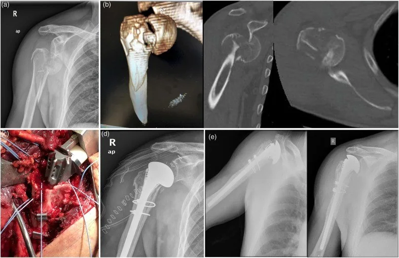 Humerus başı bölünme tipi kırığı (head-split): yayımlanmış olgu görüntüsü, 3B kesit