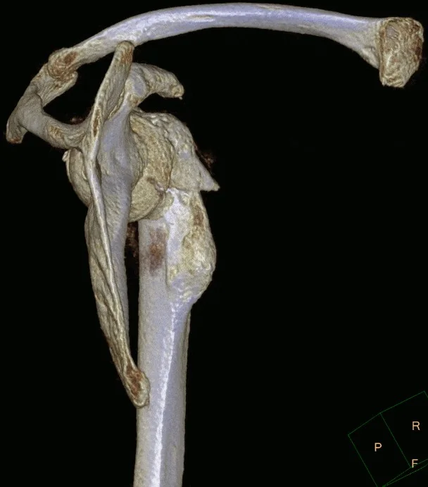 Humerus veya skapula osteokondromu: yayımlanmış olgu görüntüsü, 3B kesit