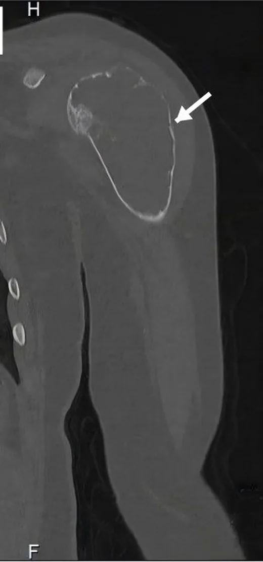 Humerus patolojik kırığı: yayımlanmış olgu görüntüsü, koronal kesit