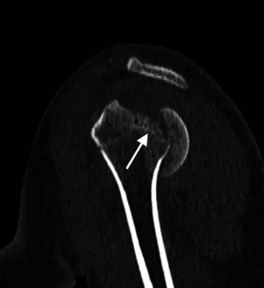 Proksimal humerus fizis kırığı: yayımlanmış olgu görüntüsü, koronal kesit