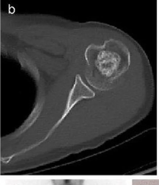 Proksimal humerus enkondromu: yayımlanmış olgu görüntüsü, aksiyel kesit