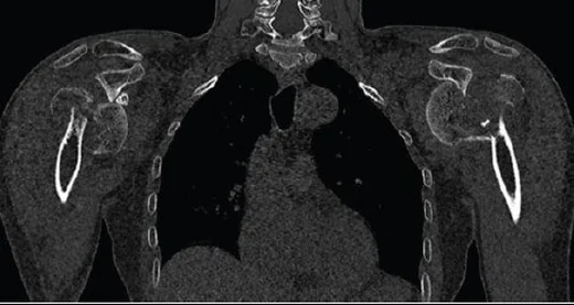 Proksimal humerus kırığı: Neer parça analizi: yayımlanmış olgu görüntüsü, koronal kesit