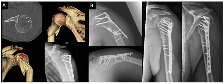 Humerus cerrahi boyun kırığı: yayımlanmış olgu görüntüsü, aksiyel kesit
