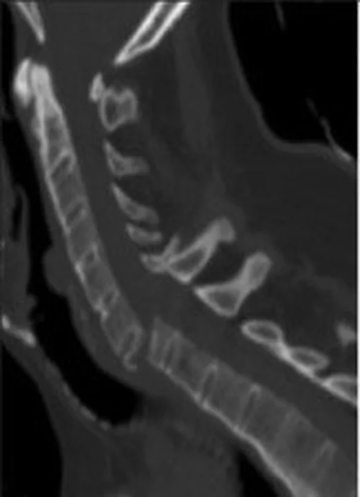 Ankilozan spondilit/DISH zemininde servikal kırık: yayımlanmış olgu görüntüsü, sagittal kesit