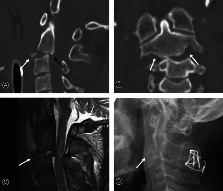 Çift taraflı faset kilitlenmesi/çıkığı: yayımlanmış olgu görüntüsü, sagittal kesit