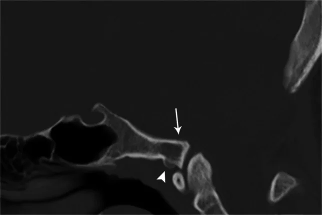 Üçüncü oksipital kondil: yayımlanmış olgu görüntüsü, sagittal kesit