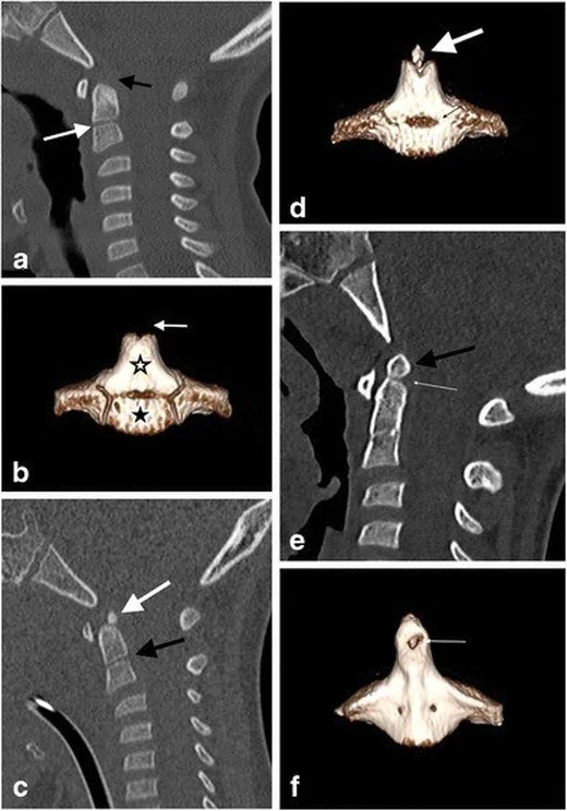 Dens gelişimsel sinkondrozu (dentosentral): yayımlanmış olgu görüntüsü, sagittal kesit