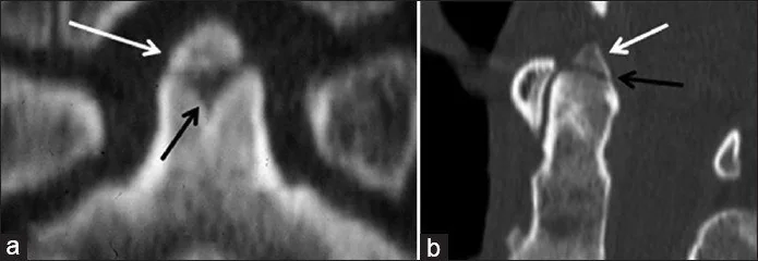 Odontoid tip I kırığı: yayımlanmış olgu görüntüsü, koronal kesit