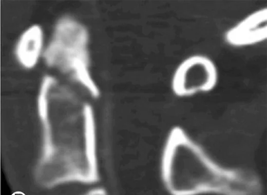 Odontoid tip II kırığı: yayımlanmış olgu görüntüsü, koronal kesit