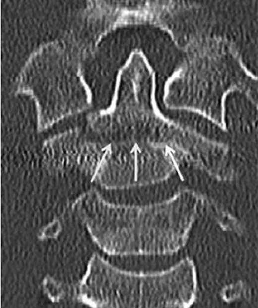 Odontoid tip III kırığı: yayımlanmış olgu görüntüsü, sagittal kesit