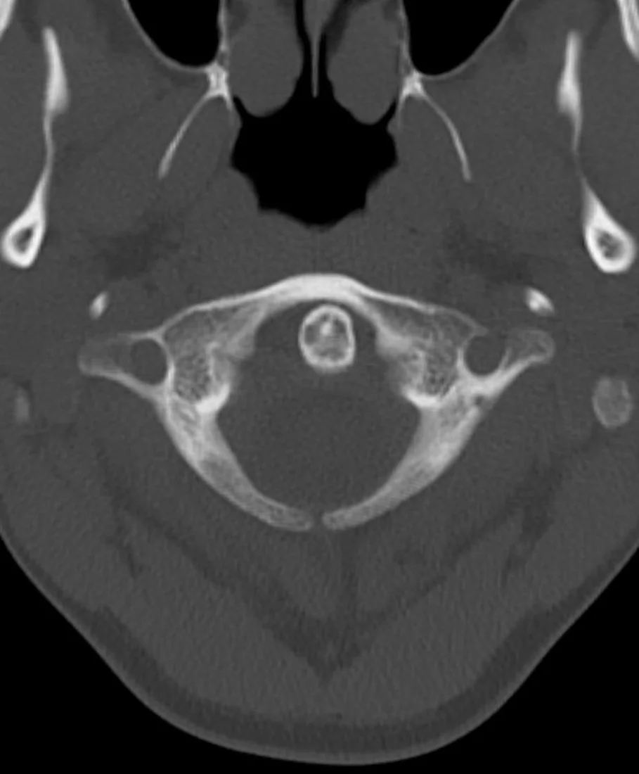 C1 posterior ark gelişimsel defekti: yayımlanmış olgu görüntüsü, aksiyel kesit