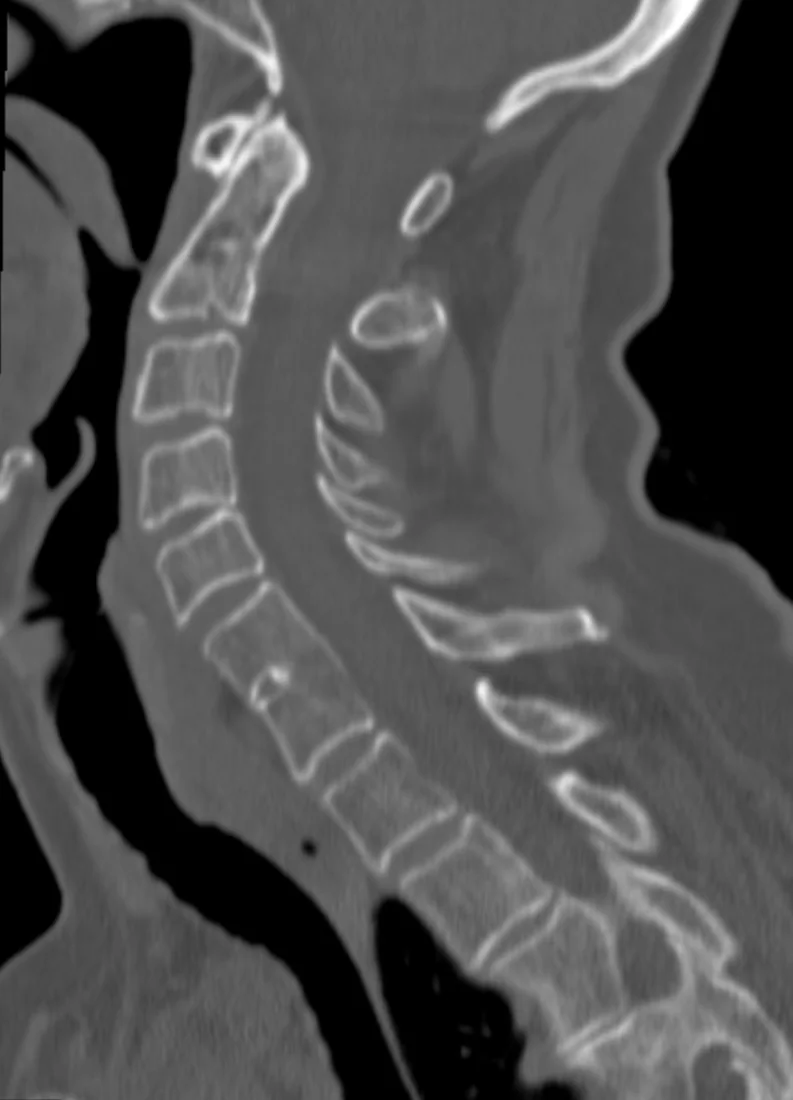 Konjenital blok vertebra (Klippel–Feil örüntüsü): yayımlanmış olgu görüntüsü, sagittal kesit