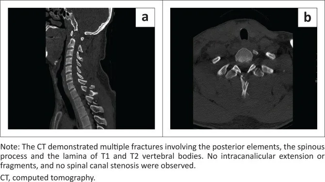 NEXUS ve Canadian C-Spine Rule bağlamı: yayımlanmış olgu görüntüsü, sagittal ve aksiyel kesit