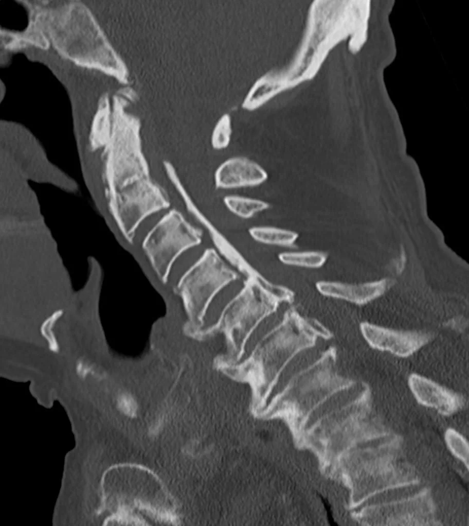 Posterior longitudinal bağ ossifikasyonu (OPLL): yayımlanmış olgu görüntüsü, sagittal kesit