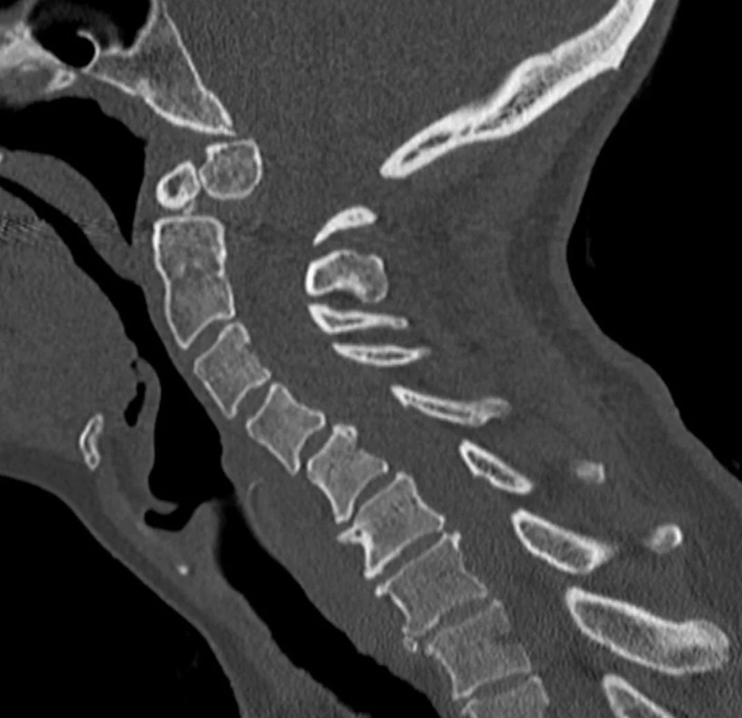 Kronik dens ossikülü ile akut kırık ayrımı: yayımlanmış olgu görüntüsü, sagittal kesit