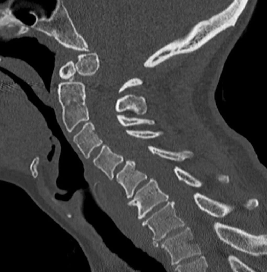 Os odontoideum: yayımlanmış olgu görüntüsü, sagittal kesit