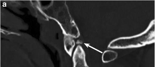 Os terminale (dens apeksi ossikülü): yayımlanmış olgu görüntüsü, sagittal kesit