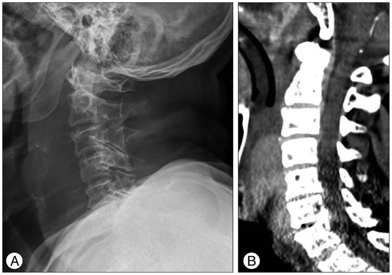 Prevertebral yumuşak doku kalınlaşması/hematom: yayımlanmış olgu görüntüsü, sagittal kesit