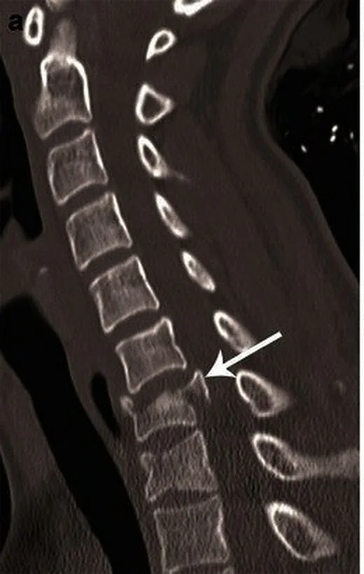 Servikal burst kırığı: yayımlanmış olgu görüntüsü, sagittal kesit