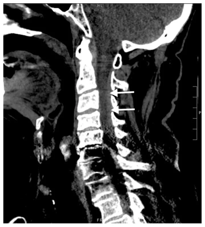 Travmatik servikal epidural hematom (BT’de dolaylı/tanı koydurucu görünüm): yayımlanmış olgu görüntüsü, sagittal kesit