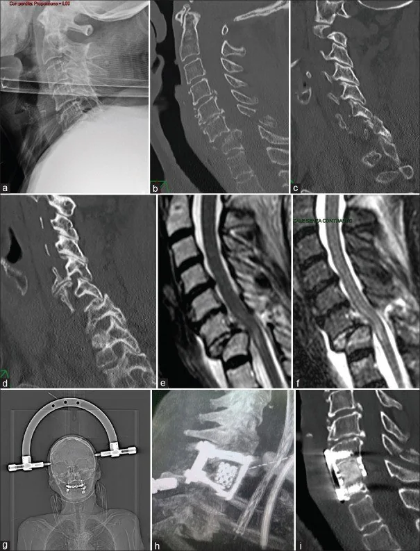Posterior fleksiyon bandı yaralanması: yayımlanmış olgu görüntüsü, sagittal kesit