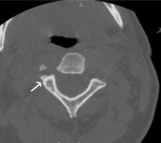 Foramen transversarium ilişkili vertebral arter yaralanma riski: yayımlanmış olgu görüntüsü, aksiyel kesit