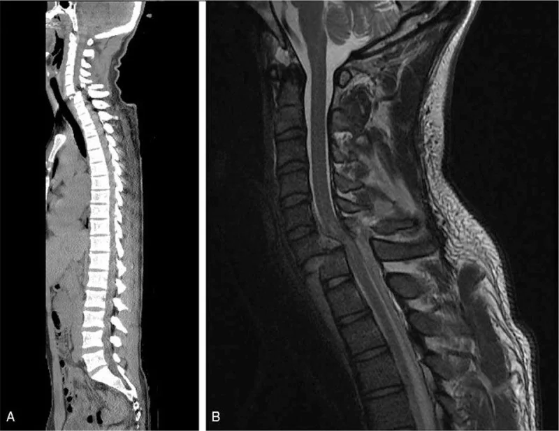 Servikal translasyonel kırık-çıkık: yayımlanmış olgu görüntüsü, sagittal kesit