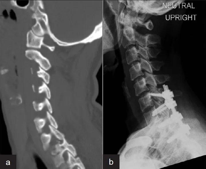 Subaxial Injury Classification (SLIC): yayımlanmış olgu görüntüsü, sagittal kesit