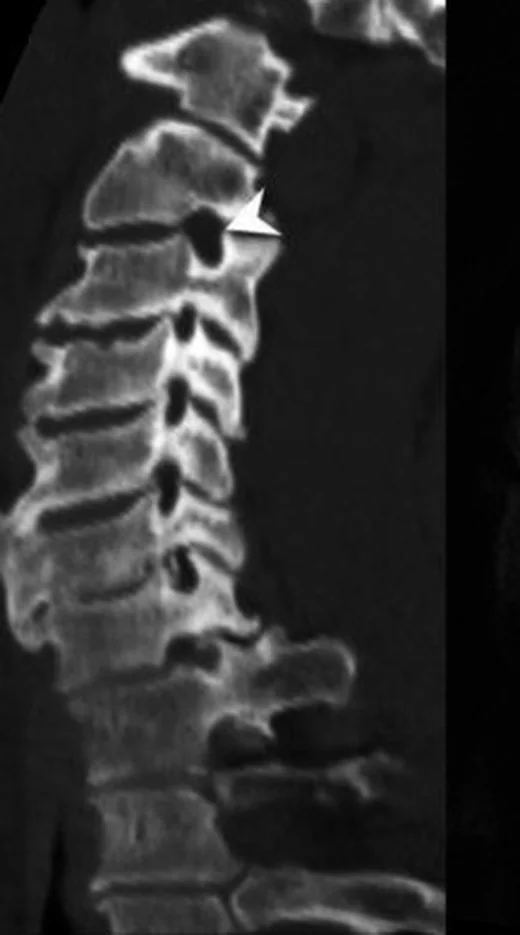 Servikal spondiloz ve osteofitler: yayımlanmış olgu görüntüsü, sagittal kesit