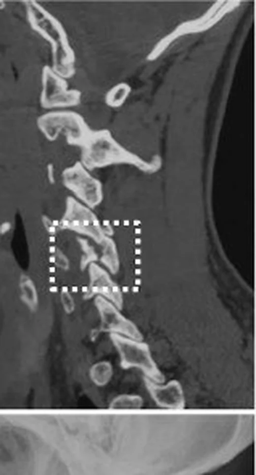 Tek taraflı faset kilitlenmesi/çıkığı: yayımlanmış olgu görüntüsü, sagittal kesit