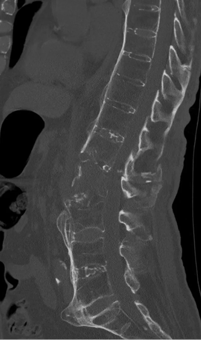 Ankilozan spondilit/DISH zemininde kırık: yayımlanmış olgu görüntüsü, sagittal kesit