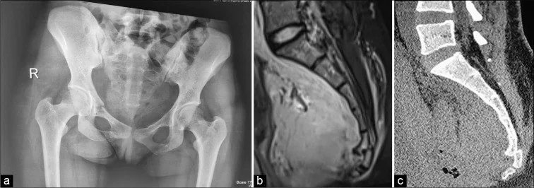 Sakrokoksigeal kırık/çıkık: yayımlanmış olgu görüntüsü, sagittal kesit