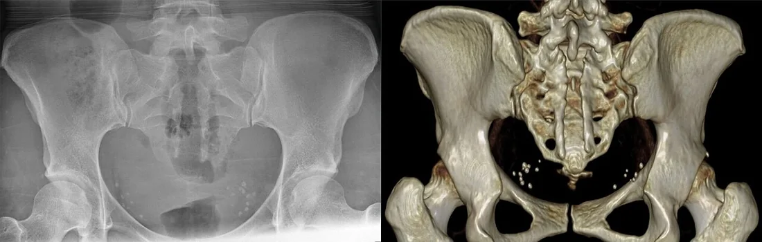 Spina bifida occulta: yayımlanmış olgu görüntüsü, 3B kesit