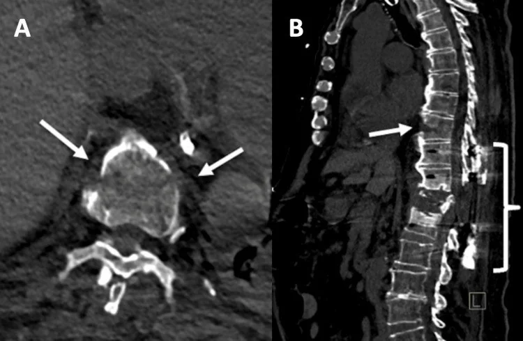 Anterior distraksiyon/hiperekstansiyon yaralanması: yayımlanmış olgu görüntüsü, sagittal kesit