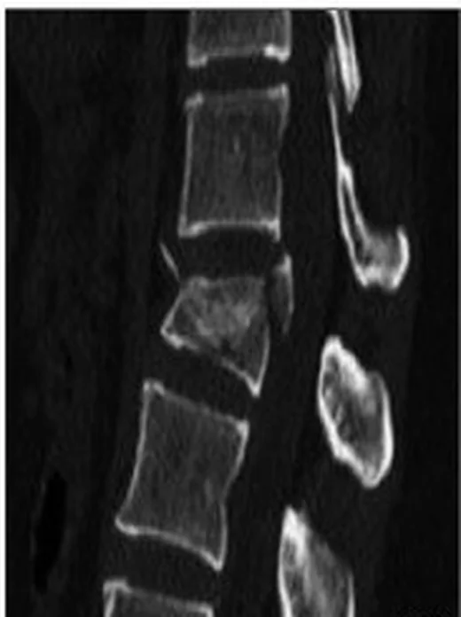 Torakolomber burst kırığı: yayımlanmış olgu görüntüsü, sagittal kesit